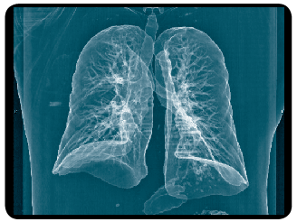 lung xray.png